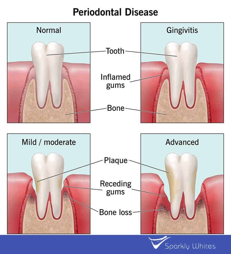 Can Gum Bleeding Really Indicate Poor Oral Hygiene Nottingham?