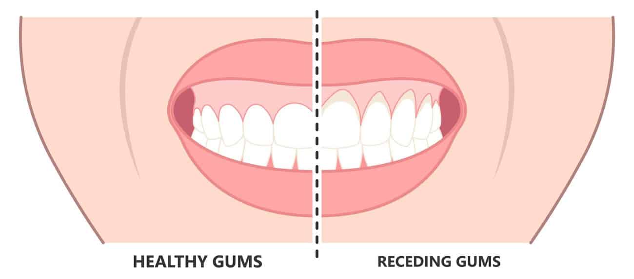 What Causes Gums to Recede Over Time Nottingham